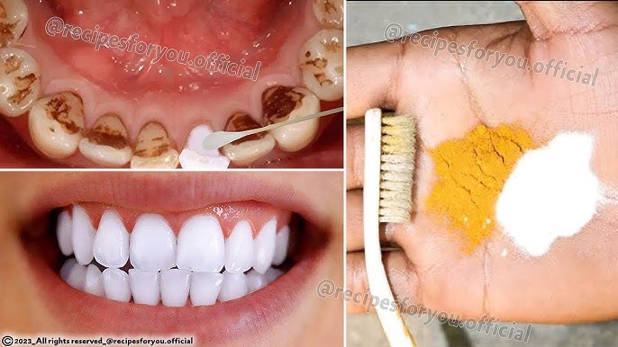 Teeth whitening in just 2 minutes – turning yellow and accumulated tartar into milk-like white and shiny. Full recipe in the first comment..  07:11:26